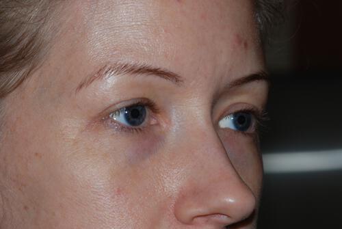 Blepharoplasty Before & After Image