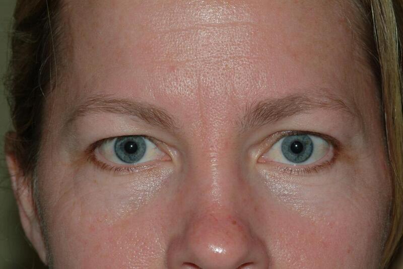 Blepharoplasty Before & After Image