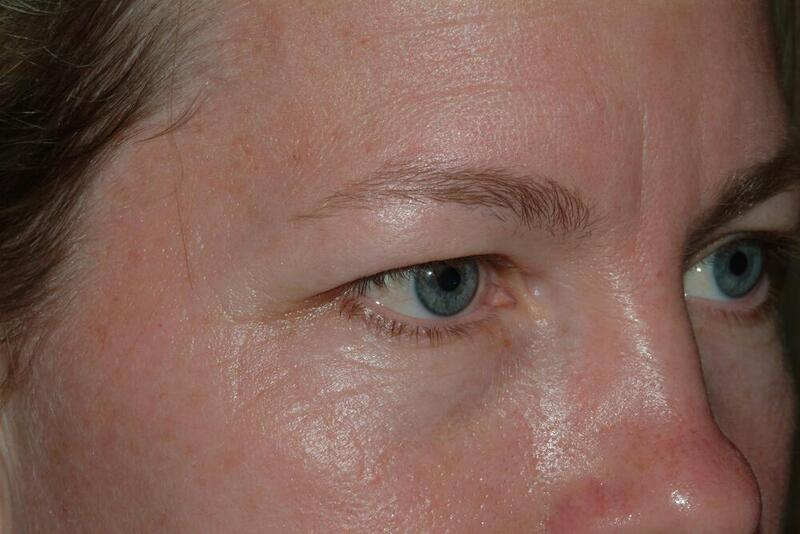 Blepharoplasty Before & After Image