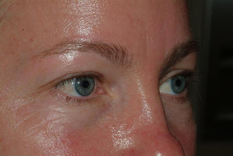 Blepharoplasty Before & After Image