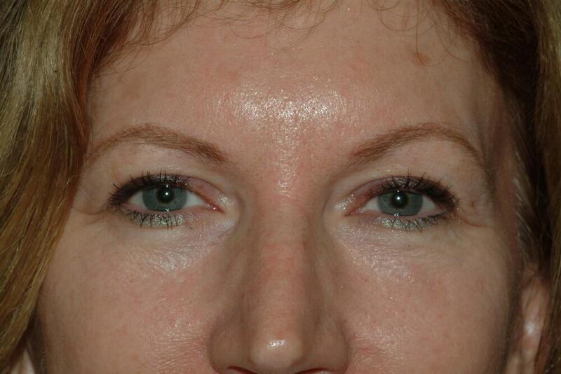 Blepharoplasty Before & After Image