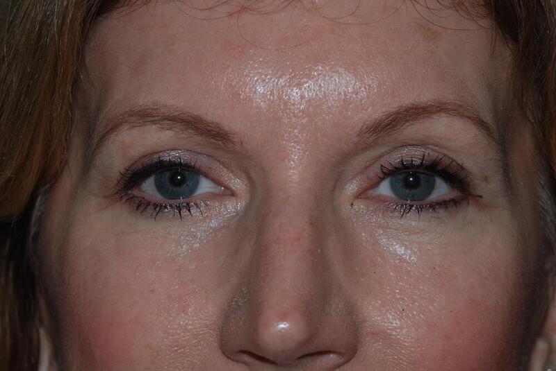 Blepharoplasty Before & After Image