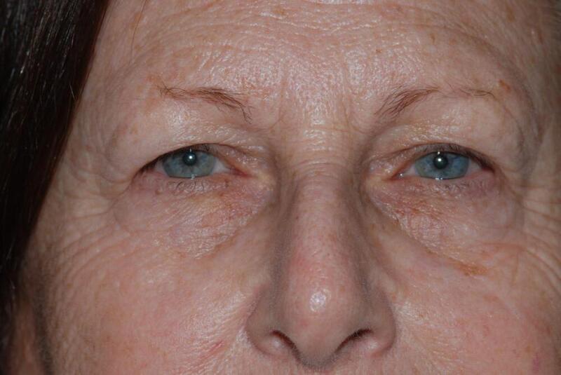 Brow Lift Before & After Image