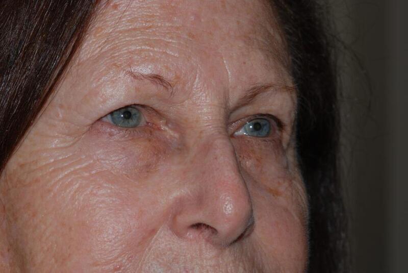 Brow Lift Before & After Image