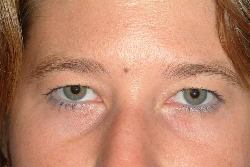 Brow Lift Before & After Image