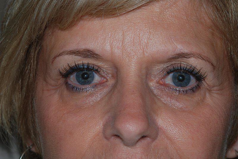 Brow Lift Before & After Image