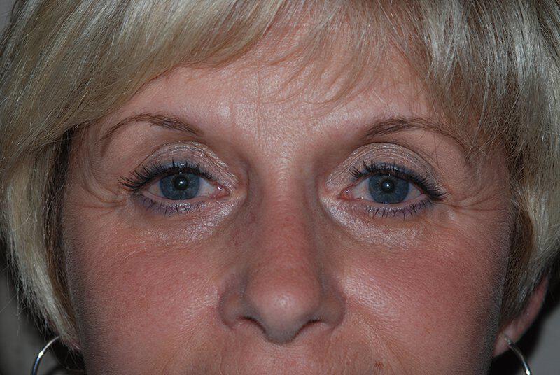 Brow Lift Before & After Image