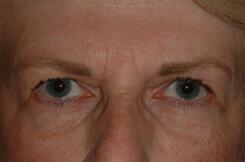 Brow Lift Before & After Image