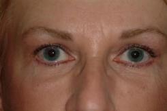 Brow Lift Before & After Image