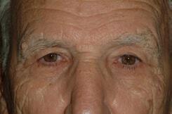 Brow Lift Before & After Image