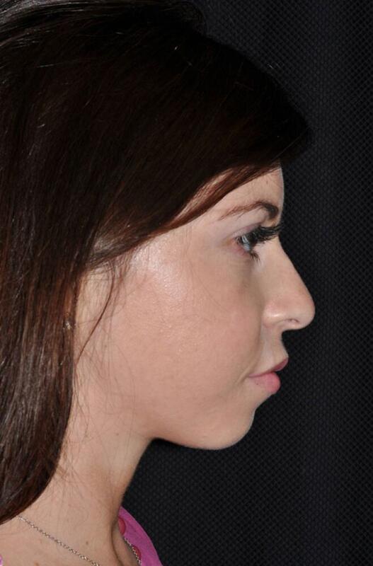 Chin Implant Before & After Image