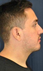 Chin Implant Before & After Image