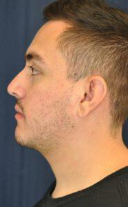 Chin Implant Before & After Image