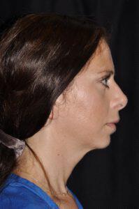 Chin Implant Before & After Image