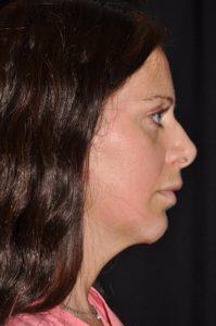 Chin Implant Before & After Image