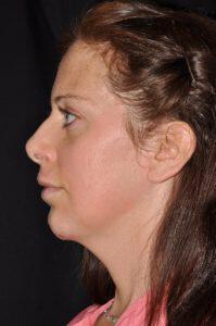 Chin Implant Before & After Image