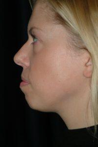 Chin Implant Before & After Image