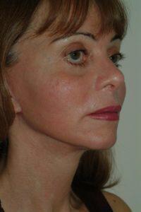 Chin Implant Before & After Image