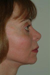 Chin Implant Before & After Image