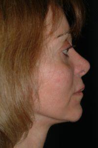 Chin Implant Before & After Image