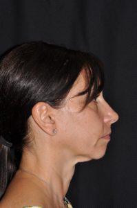 Chin Implant Before & After Image