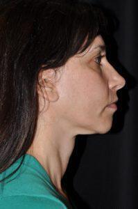 Chin Implant Before & After Image