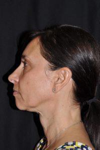 Chin Implant Before & After Image