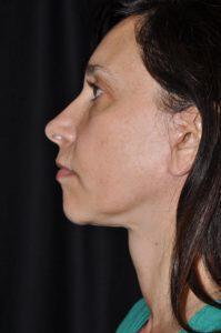 Chin Implant Before & After Image