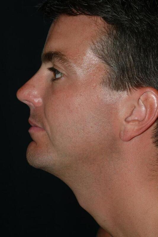 Chin Implant Before & After Image