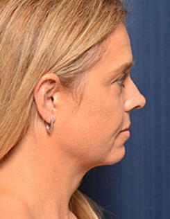 Chin & Neck Liposuction Before & After Image