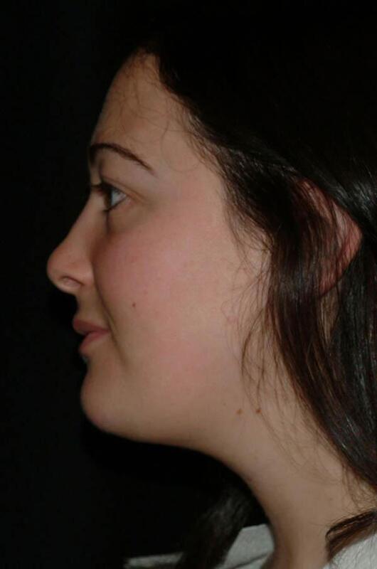 Chin & Neck Liposuction Before & After Image