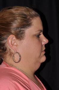 Chin & Neck Liposuction Before & After Image