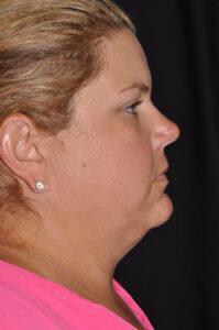 Chin & Neck Liposuction Before & After Image