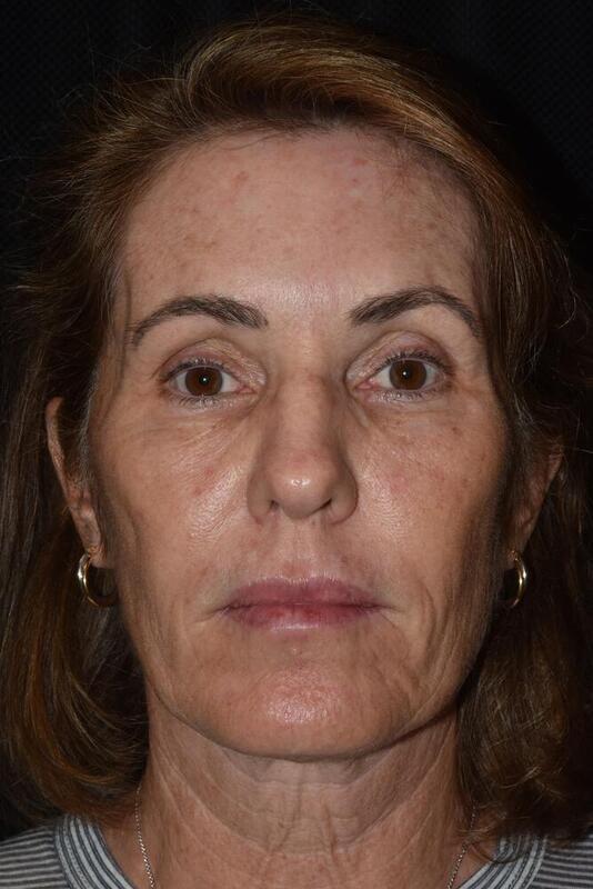 Facelift Before & After Image