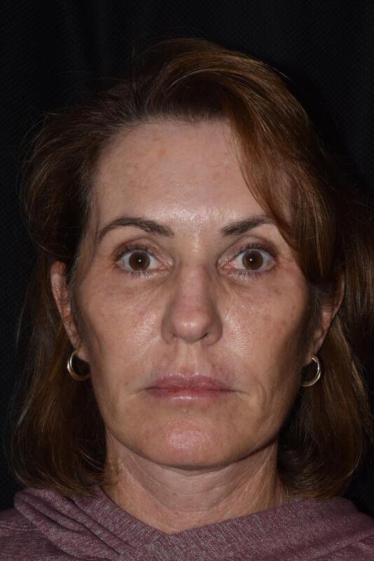 Facelift Before & After Image