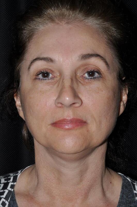 Facelift Before & After Image