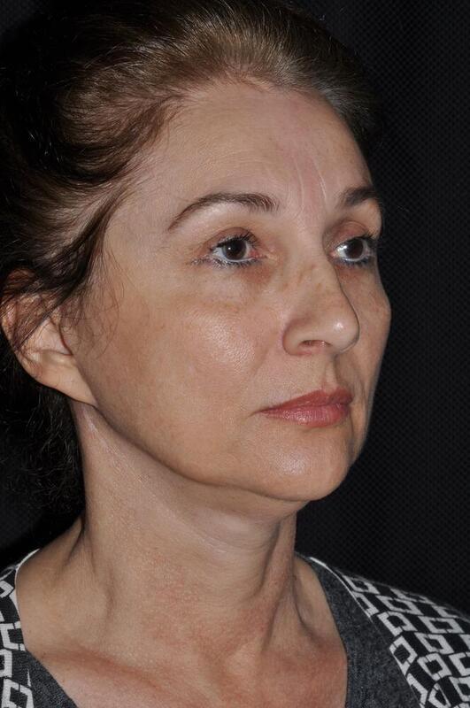 Facelift Before & After Image