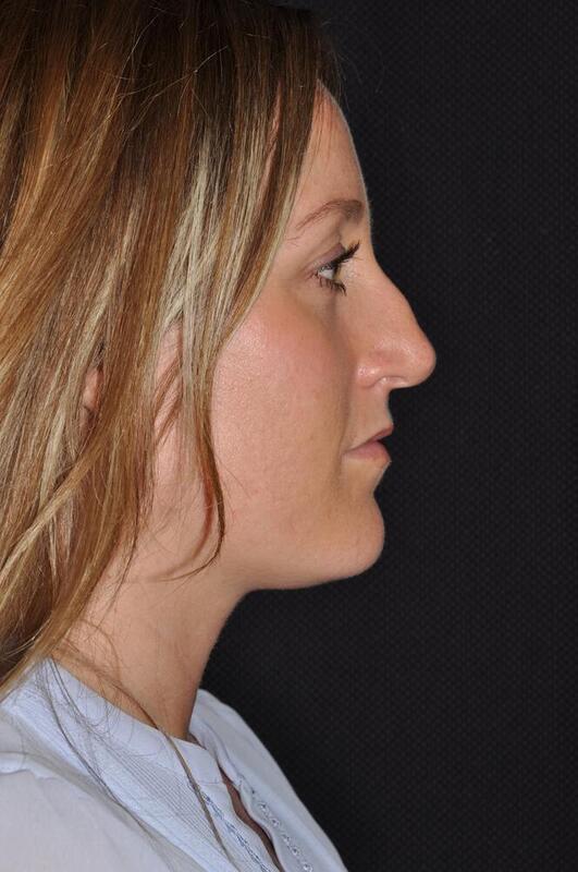 Rhinoplasty Before & After Image