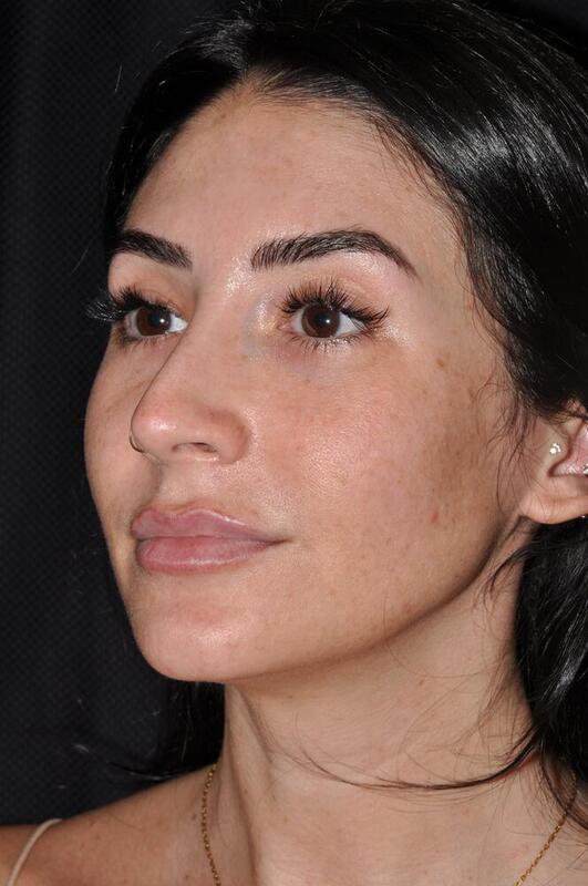 Rhinoplasty Before & After Image