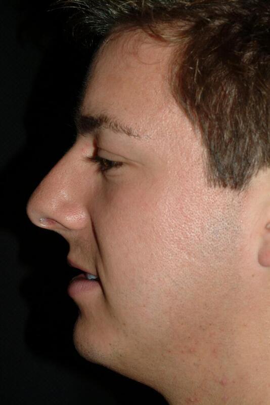 Rhinoplasty Before & After Image