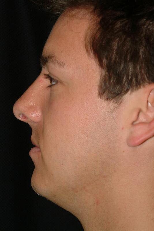 Rhinoplasty Before & After Image