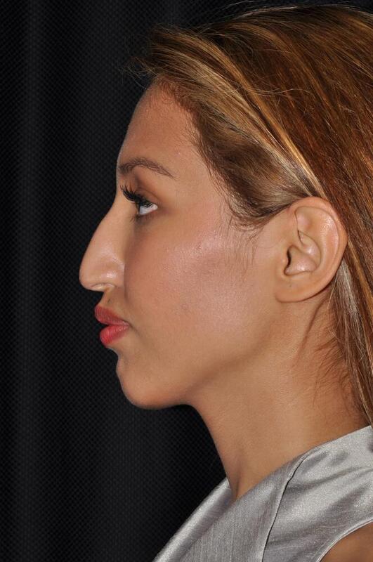 Rhinoplasty Before & After Image