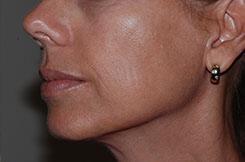 Dermal Fillers & Injectables Before & After Image