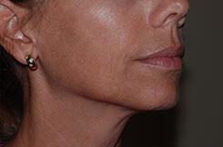 Dermal Fillers & Injectables Before & After Image