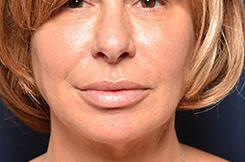 Dermal Fillers & Injectables Before & After Image