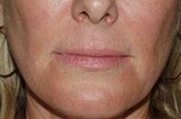 Lip Augmentation Before & After Image